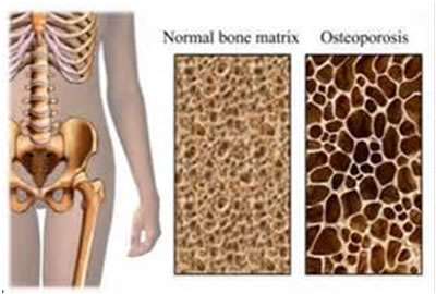 Alkali_diyet_Osteoporoz