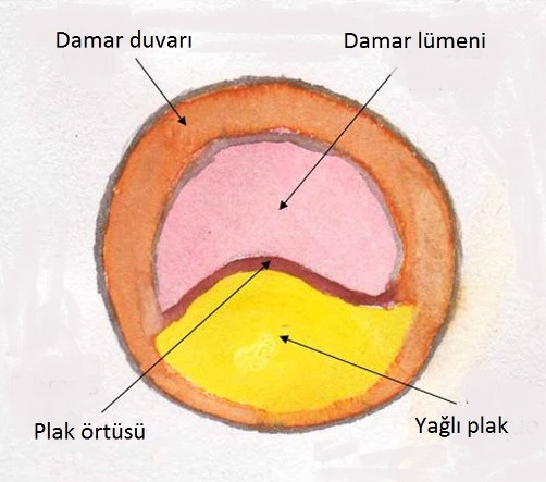 Damar sertliğine bağlı kalp ve damar hastalarına statin şarttır!